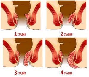 Признаки и симптомы заболеваний прямой кишки у женщин и мужчин